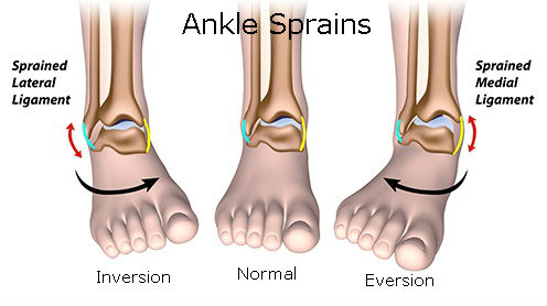 Ankle Sprains