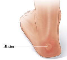 Blister