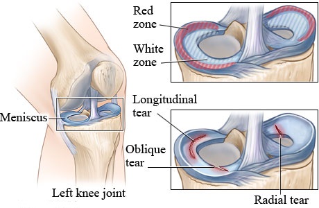 Meniscus Tear