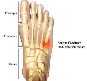 Metatarsal Stress Fracture