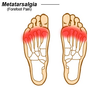 Metatarsalgia