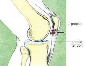 Patellar Tendinitis