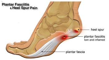 Plantar Fasciitis