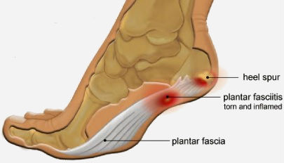 Plantar Fasciitis