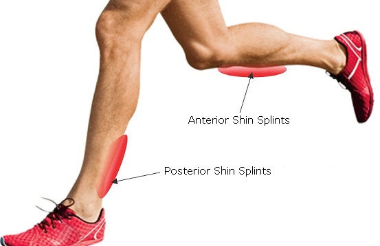 SHIN SPLINTS (MEDIAL TIBIAL STRESS SYNDROME) 
