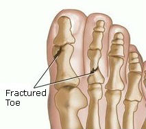 Fractured Toe